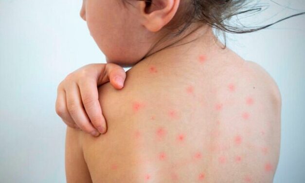 Sarampión: alerta por la aparición de brotes en la región