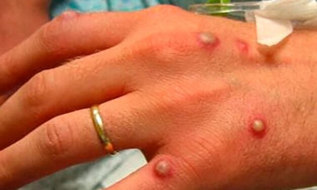 Viruela del mono: qué es y cuáles son los síntomas de la enfermedad